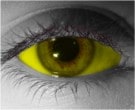 Yellow Sclera